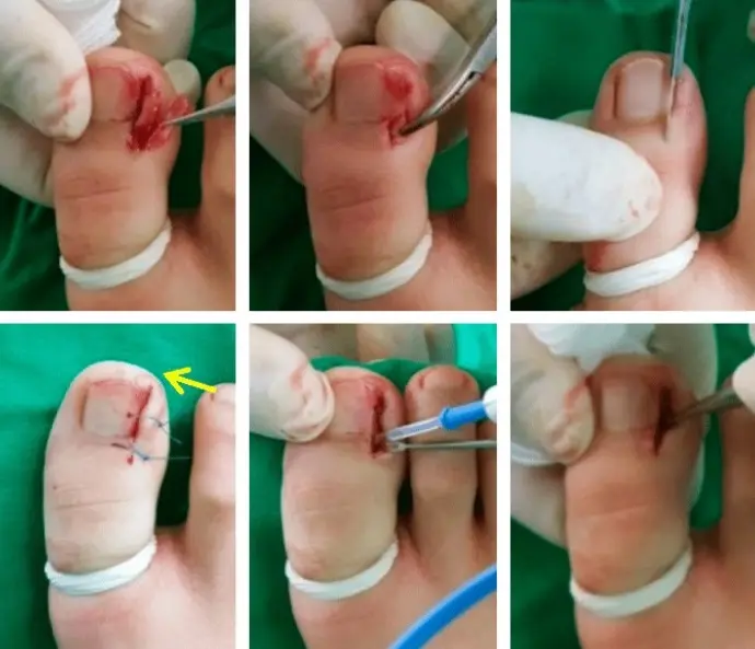 techniques chirurgicales pour ongle incarné au pied