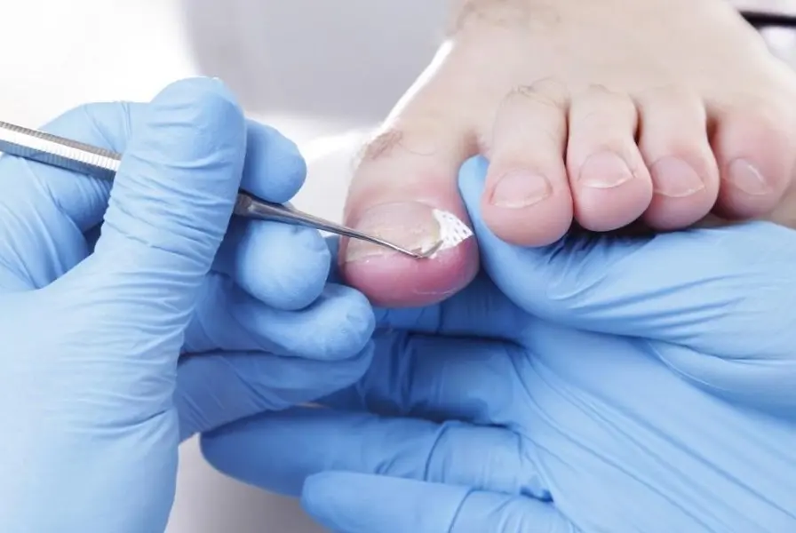 techniques de prévention de l'ongle incarné au pied
