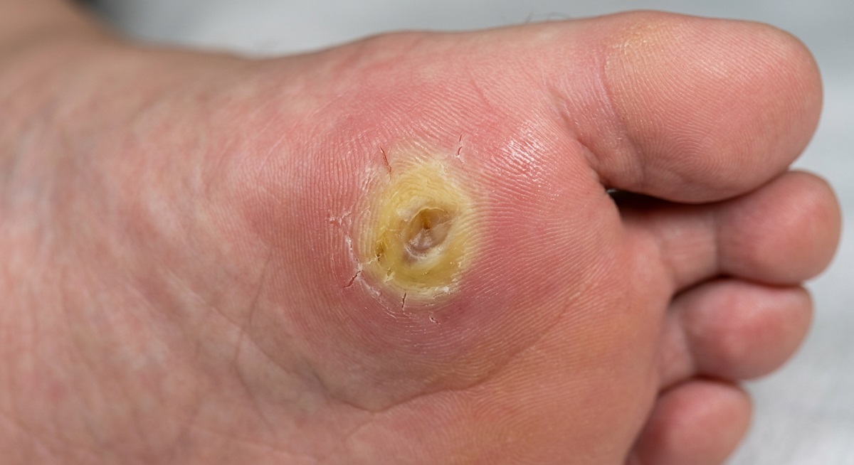 Gros plan sur les zones d'inflammation d'un durillon plantaire douloureux profond